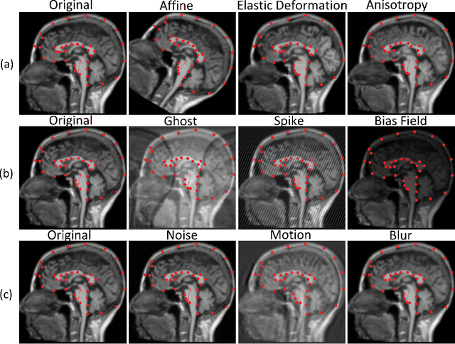 Figure 4 for Simulating Realistic MRI variations to Improve Deep Learning model and visual explanations using GradCAM