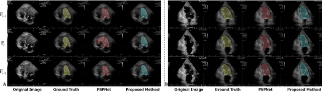 Figure 1 for TAN: Temporal Affine Network for Real-Time Left Ventricle Anatomical Structure Analysis Based on 2D Ultrasound Videos