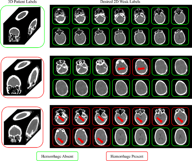 Figure 1 for Extracting 2D weak labels from volume labels using multiple instance learning in CT hemorrhage detection