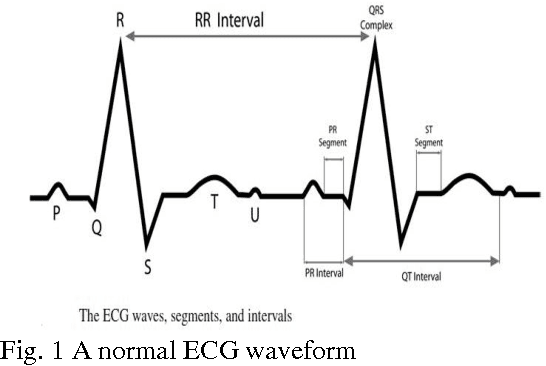 Figure 1 for Adaptive Wavelet Based Identification and Extraction of PQRST Combination in Randomly Stretching ECG Sequence