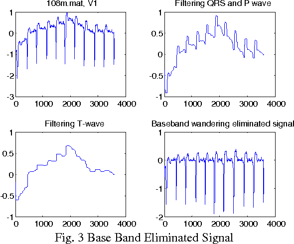 Figure 3 for Adaptive Wavelet Based Identification and Extraction of PQRST Combination in Randomly Stretching ECG Sequence