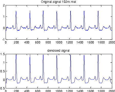 Figure 4 for Adaptive Wavelet Based Identification and Extraction of PQRST Combination in Randomly Stretching ECG Sequence