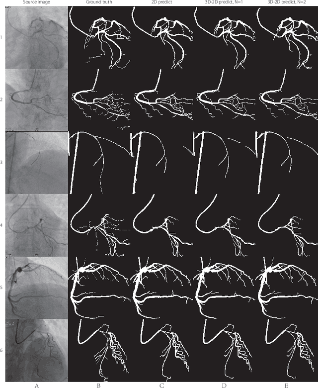 Figure 3 for Coronary Artery Segmentation in Angiographic Videos Using A 3D-2D CE-Net