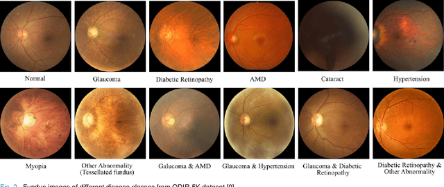 Figure 2 for Discriminative Kernel Convolution Network for Multi-Label Ophthalmic Disease Detection on Imbalanced Fundus Image Dataset