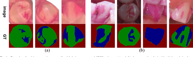 Figure 1 for Semantic decomposition Network with Contrastive and Structural Constraints for Dental Plaque Segmentation