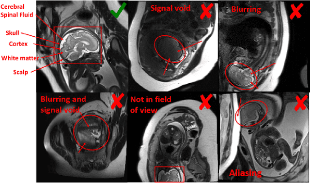 Figure 3 for Semi-Supervised Learning for Fetal Brain MRI Quality Assessment with ROI consistency