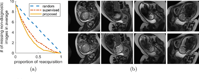 Figure 4 for Semi-Supervised Learning for Fetal Brain MRI Quality Assessment with ROI consistency