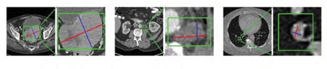 Figure 1 for RECIST-Net: Lesion detection via grouping keypoints on RECIST-based annotation
