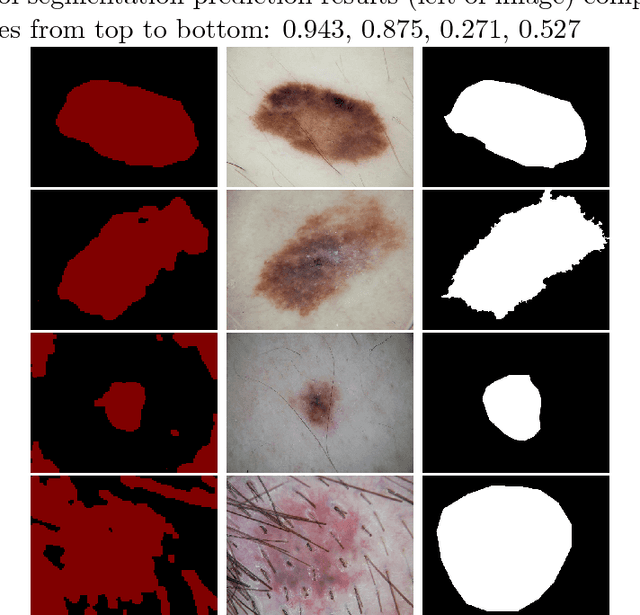 Figure 1 for Skin Lesion Segmentation Using Atrous Convolution via DeepLab v3