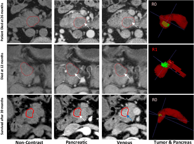 Figure 1 for DeepPrognosis: Preoperative Prediction of Pancreatic Cancer Survival and Surgical Margin via Contrast-Enhanced CT Imaging