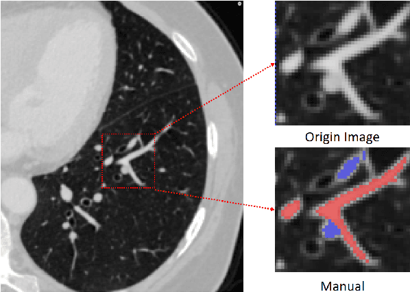 Figure 1 for Automatic Pulmonary Artery and Vein Separation Algorithm Based on Multitask Classification Network and Topology Reconstruction in Chest CT Images