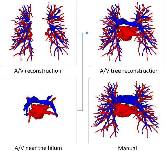 Figure 4 for Automatic Pulmonary Artery and Vein Separation Algorithm Based on Multitask Classification Network and Topology Reconstruction in Chest CT Images