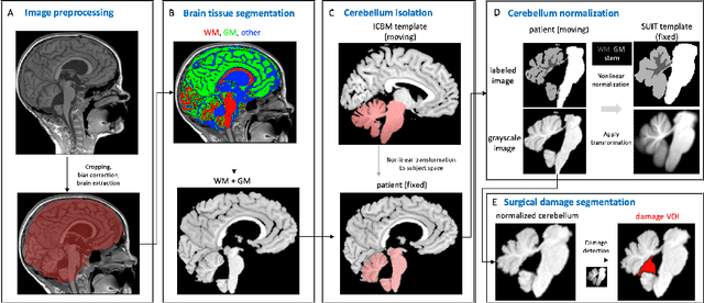Figure 1 for Automatic Detection and Segmentation of Postoperative Cerebellar Damage Based on Normalization
