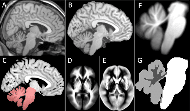 Figure 3 for Automatic Detection and Segmentation of Postoperative Cerebellar Damage Based on Normalization