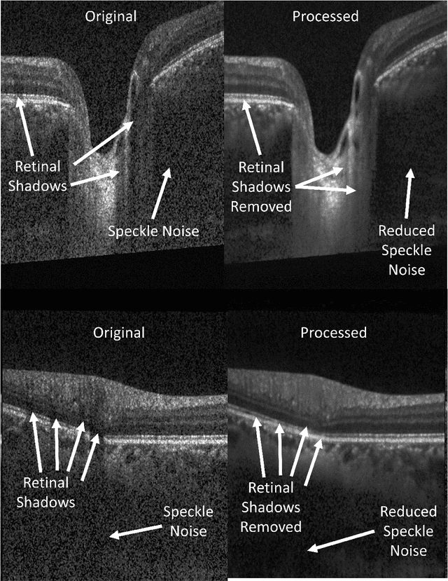 Figure 3 for OCT-GAN: Single Step Shadow and Noise Removal from Optical Coherence Tomography Images of the Human Optic Nerve Head