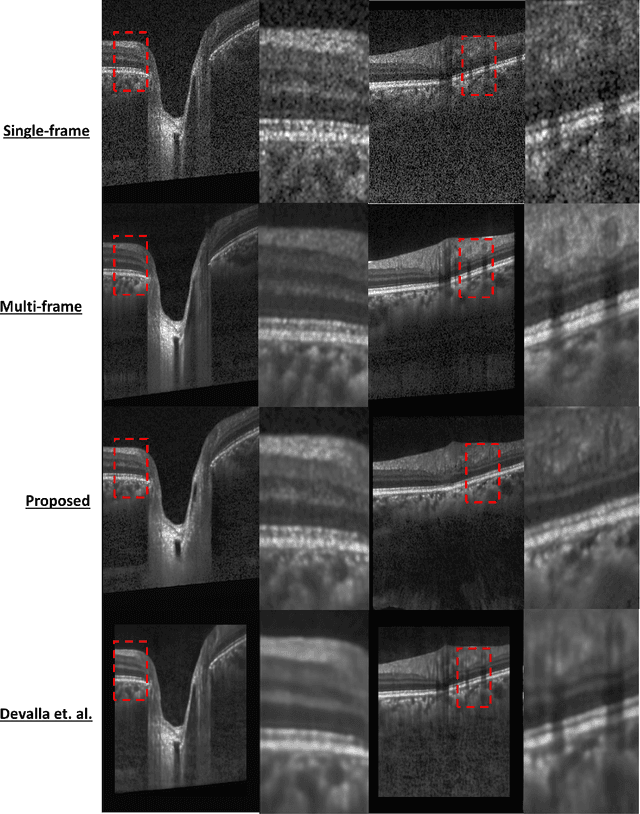 Figure 4 for OCT-GAN: Single Step Shadow and Noise Removal from Optical Coherence Tomography Images of the Human Optic Nerve Head