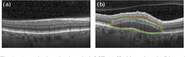 Figure 1 for Exploiting Epistemic Uncertainty of Anatomy Segmentation for Anomaly Detection in Retinal OCT