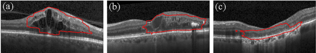 Figure 3 for Exploiting Epistemic Uncertainty of Anatomy Segmentation for Anomaly Detection in Retinal OCT