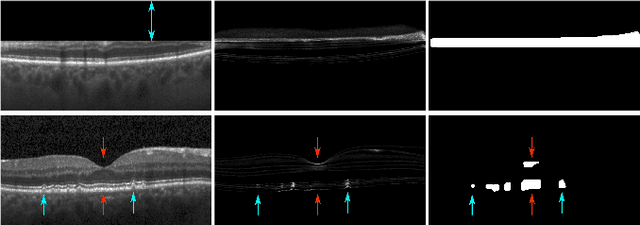 Figure 4 for Exploiting Epistemic Uncertainty of Anatomy Segmentation for Anomaly Detection in Retinal OCT