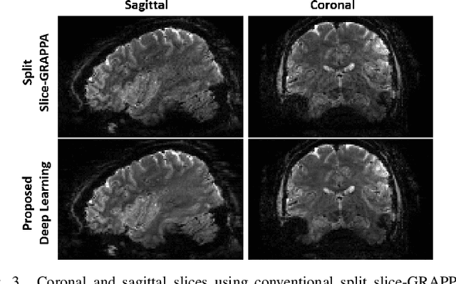 Figure 3 for Improved Simultaneous Multi-Slice Functional MRI Using Self-supervised Deep Learning