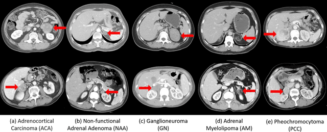 Figure 1 for Deep Multi-Scale Resemblance Network for the Sub-class Differentiation of Adrenal Masses on Computed Tomography Images