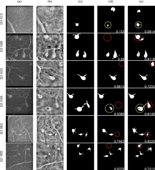 Figure 4 for AOSLO-net: A deep learning-based method for automatic segmentation of retinal microaneurysms from adaptive optics scanning laser ophthalmoscope images