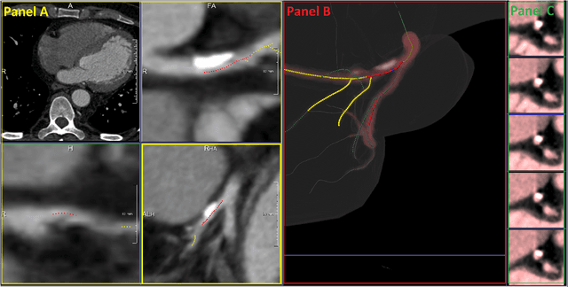 Figure 1 for Coronary Artery Classification and Weakly Supervised Abnormality Localization on Coronary CT Angiography with 3-Dimensional Convolutional Neural Networks
