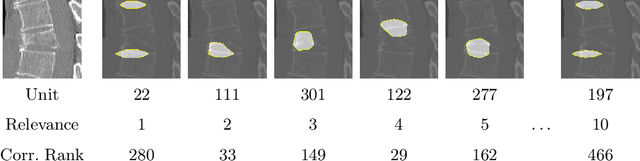 Figure 3 for Interpretable Vertebral Fracture Diagnosis