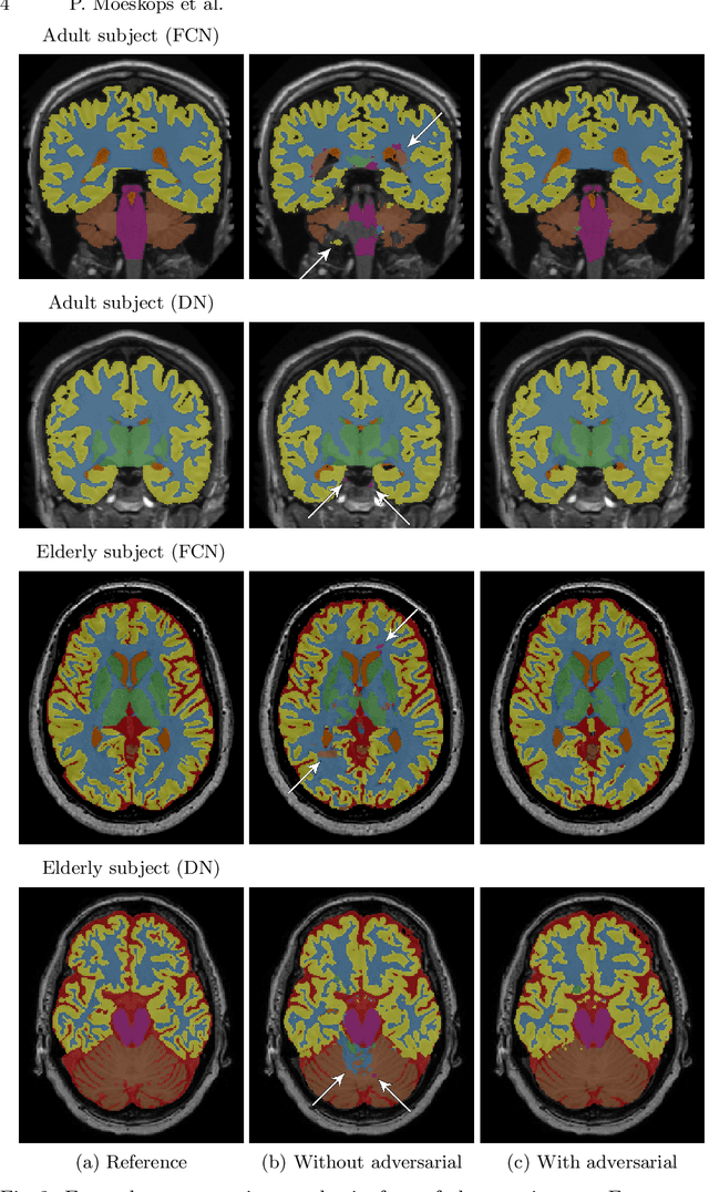 Figure 2 for Adversarial training and dilated convolutions for brain MRI segmentation