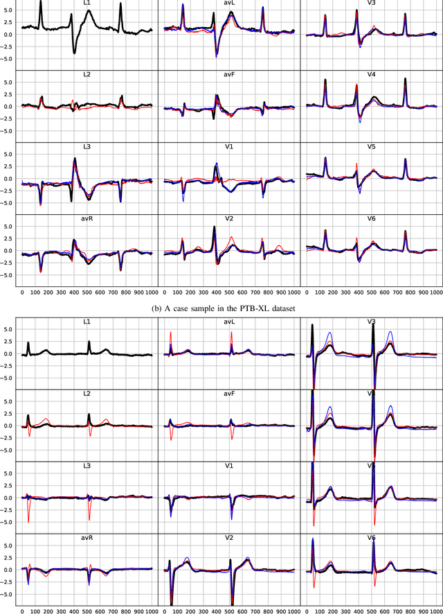 Figure 4 for ECGT2T: Electrocardiogram synthesis from Two asynchronous leads to Ten leads