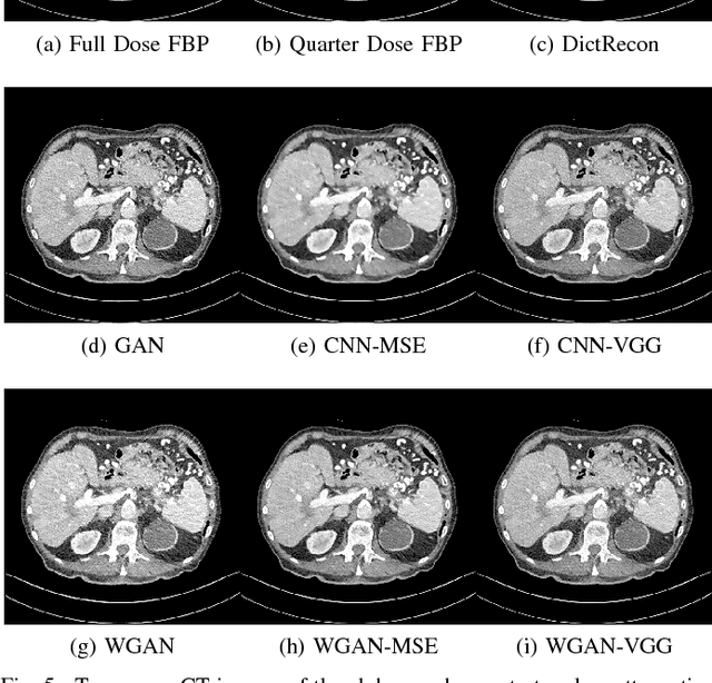 Figure 4 for Low Dose CT Image Denoising Using a Generative Adversarial Network with Wasserstein Distance and Perceptual Loss