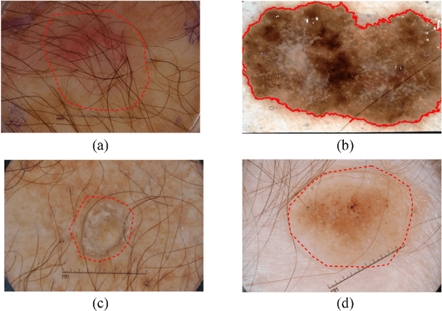 Figure 1 for Automatic skin lesion segmentation with fully convolutional-deconvolutional networks