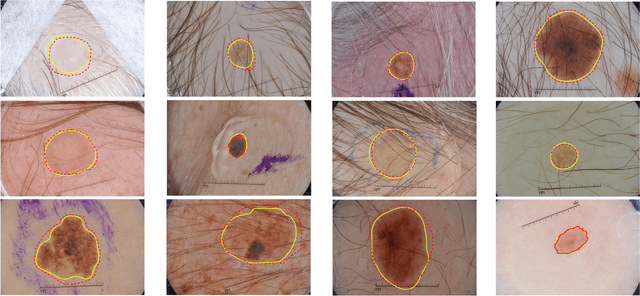 Figure 4 for Improving Dermoscopic Image Segmentation with Enhanced Convolutional-Deconvolutional Networks