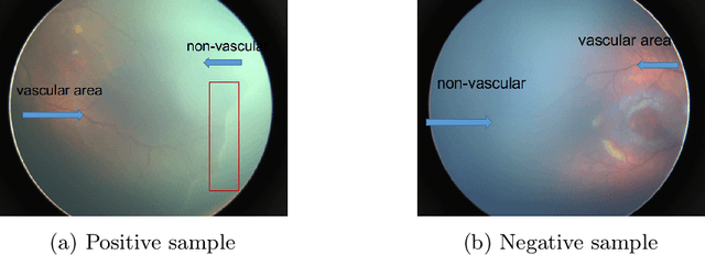 Figure 1 for Early Detection of Retinopathy of Prematurity  in Retinal Fundus Images Via Convolutional Neural Networks