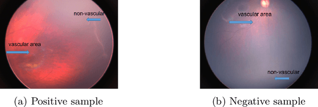 Figure 2 for Early Detection of Retinopathy of Prematurity (ROP) in Retinal Fundus Images Via Convolutional Neural Networks