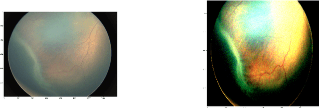 Figure 3 for Early Detection of Retinopathy of Prematurity  in Retinal Fundus Images Via Convolutional Neural Networks