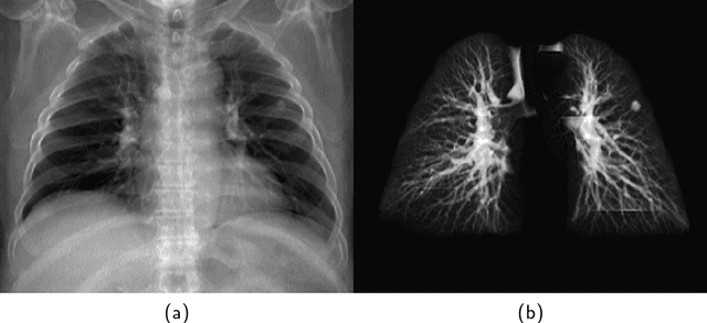 Figure 4 for Lung Structures Enhancement in Chest Radiographs via CT based FCNN Training