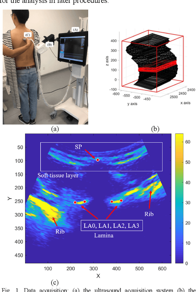 Figure 1 for Automatic segmentation of vertebral features on ultrasound spine images using Stacked Hourglass Network