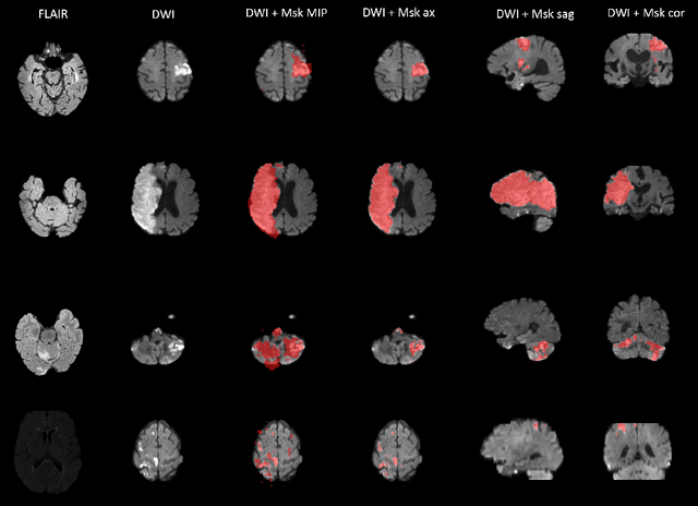 Figure 2 for ISLES 2022: A multi-center magnetic resonance imaging stroke lesion segmentation dataset