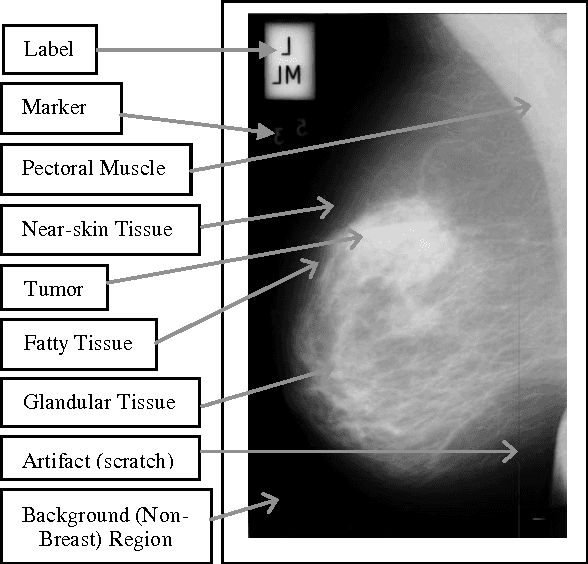 Figure 1 for Segmentation of Breast Regions in Mammogram Based on Density: A Review