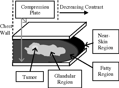 Figure 2 for Segmentation of Breast Regions in Mammogram Based on Density: A Review