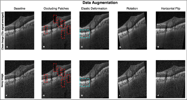 Figure 2 for A Deep Learning Approach to Denoise Optical Coherence Tomography Images of the Optic Nerve Head