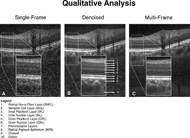 Figure 3 for A Deep Learning Approach to Denoise Optical Coherence Tomography Images of the Optic Nerve Head