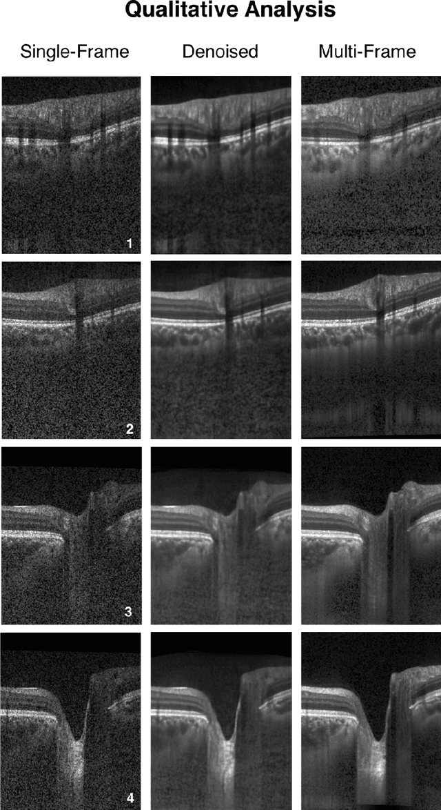 Figure 4 for A Deep Learning Approach to Denoise Optical Coherence Tomography Images of the Optic Nerve Head