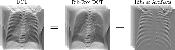 Figure 1 for Rib Suppression in Digital Chest Tomosynthesis