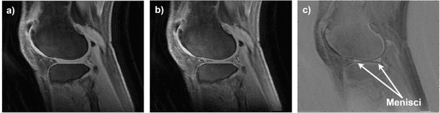 Figure 2 for Knee menisci segmentation and relaxometry of 3D ultrashort echo time (UTE) cones MR imaging using attention U-Net with transfer learning