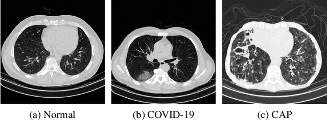 Figure 1 for Detecting COVID-19 and Community Acquired Pneumonia using Chest CT scan images with Deep Learning