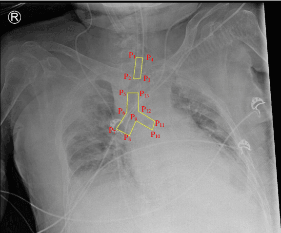Figure 1 for Development of Automatic Endotracheal Tube and Carina Detection on Portable Supine Chest Radiographs using Artificial Intelligence
