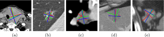 Figure 1 for Semi-Automatic RECIST Labeling on CT Scans with Cascaded Convolutional Neural Networks
