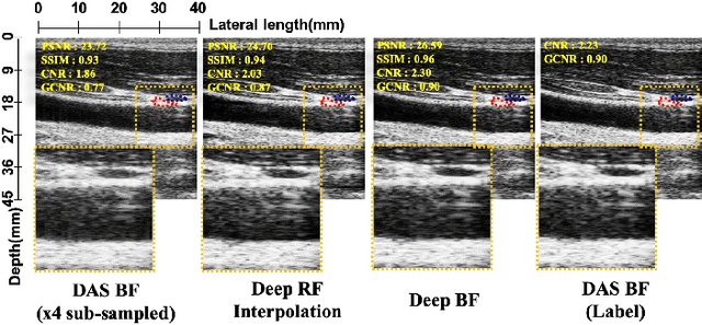 Figure 2 for Adaptive and Compressive Beamforming using Deep Learning for Medical Ultrasound
